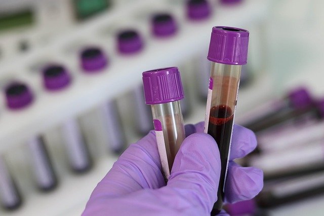 Un laborator de analize din Ploieşti va face teste de sânge pentru identificarea anticorpilor anti SARS-CoV-2 IgG si anti COVID-19